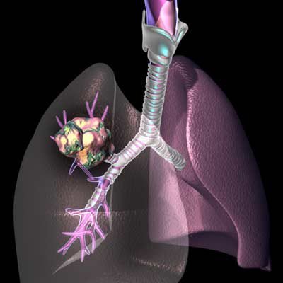 El cáncer de pulmón es el segundo cáncer más común en Venezuela